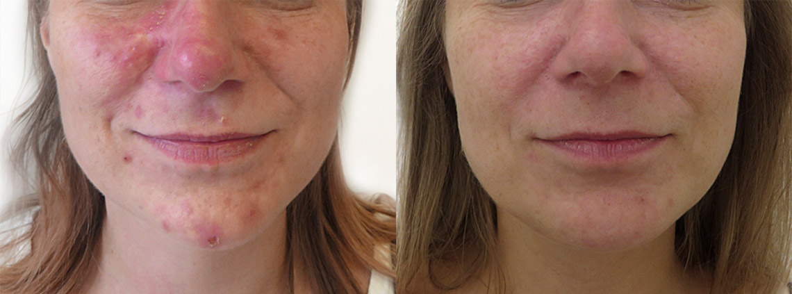 Laser treatment of dilated capillaries, removal of erythemas, management of acne rosacea (Fotona Dynamis Sp)