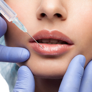 Lip augmentation and lifting with hyaluronic acid